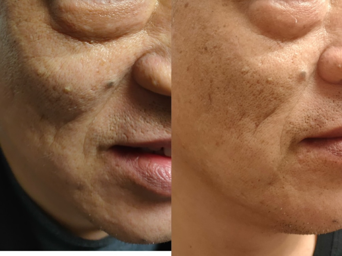 使用者反馈照片:案例 5,同一张照片内为使用前与使用后对比。